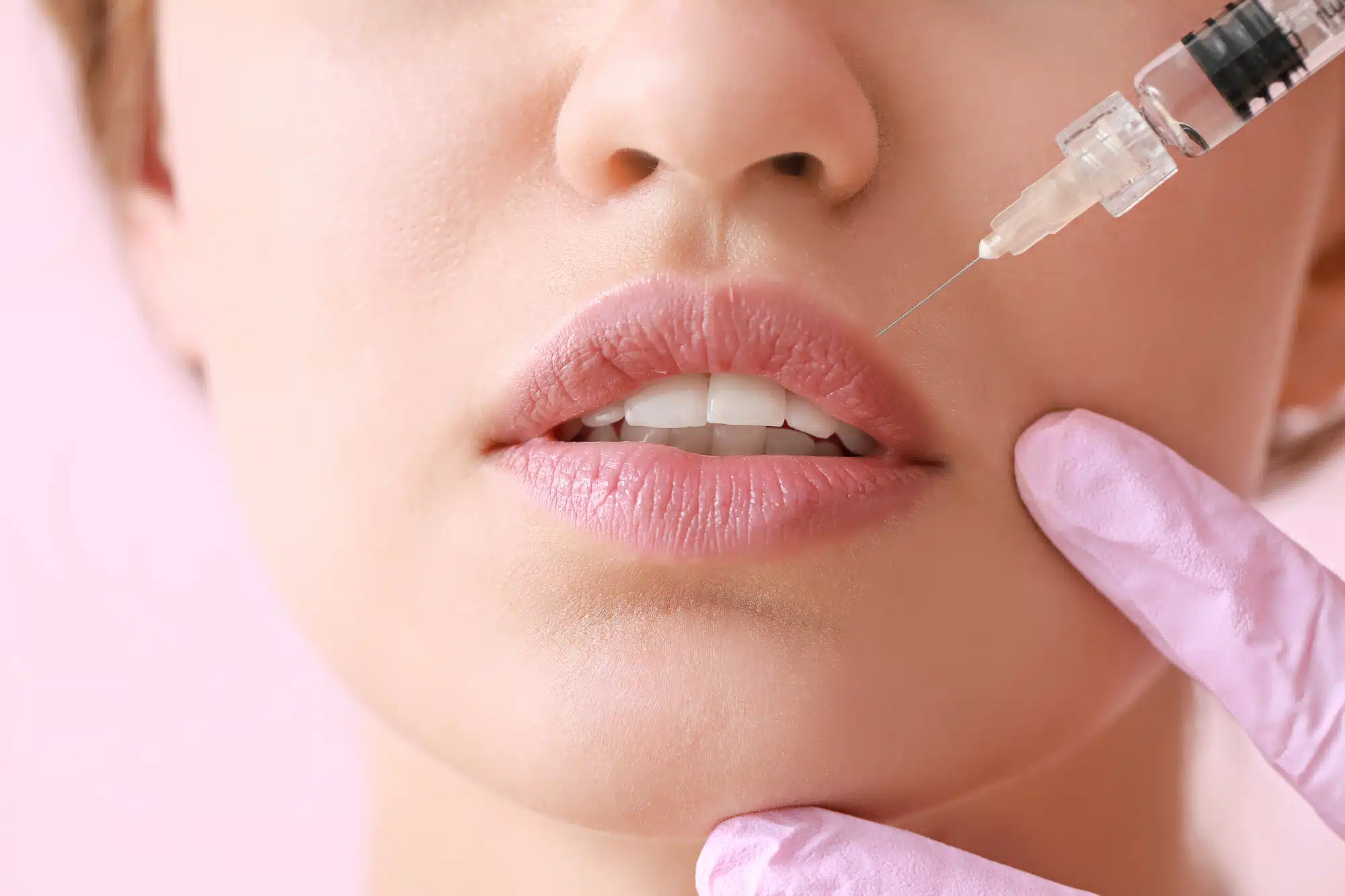 Understanding Lip Filler Swelling Stages: A Complete Guide